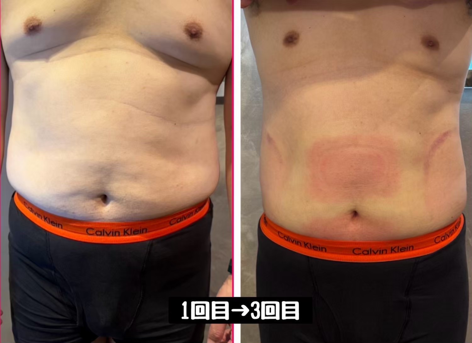 脂肪冷却痩身 1回目から3回目 お腹まわりの変化（男性）